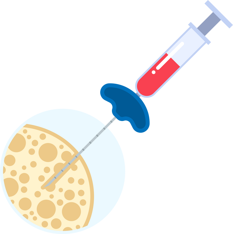 needle acute tap lumbar pancytopenia thrombocytosis lymphoblastic examine iron deficiency pain transplant myelofibrosis smear  sample Stem exam cell blood pelvic bone polycythemia vera medical